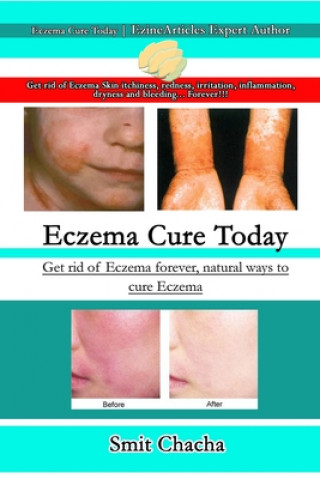 Book Eczema Cure Today - Get rid of Eczema forever natural ways to cure Eczema SMIT CHACHA