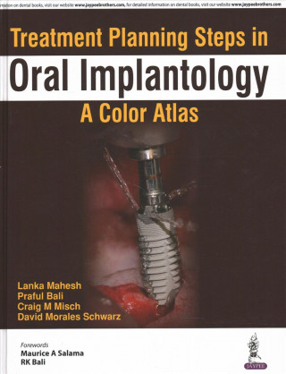 Book Treatment Planning Steps in Oral Implantology Lanka Mahesh