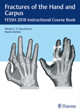 Carte Fractures of the Hand and Carpus Martin Richter