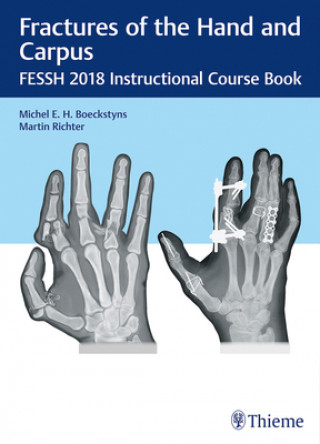 Libro Fractures of the Hand and Carpus Martin Richter