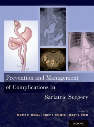 Książka Prevention and Management of Complications in Bariatric Surgery Tomasz G. Rogula