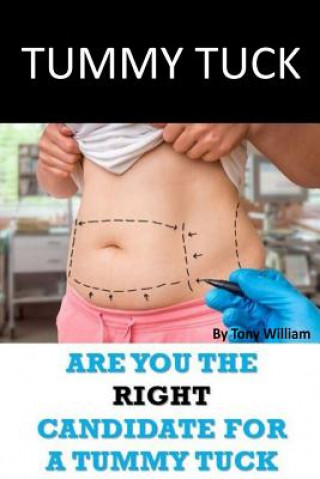 Kniha Tummy Tuck: Are You The Right Candidate For A Tummy Tuck Tony William