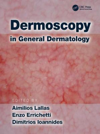 Książka Dermoscopy in General Dermatology 