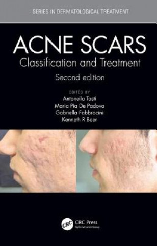 Carte Acne Scars 