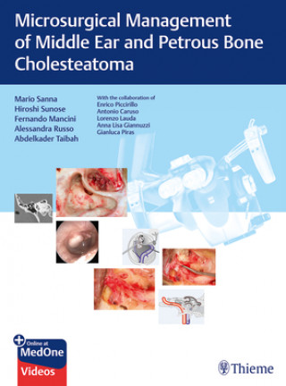 Książka Microsurgical Management of Middle Ear and Petrous Bone Cholesteatoma Mario Sanna