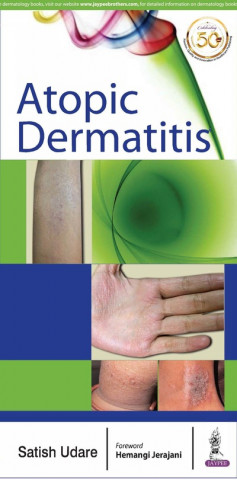 Knjiga Atopic Dermatitis Satish Udare