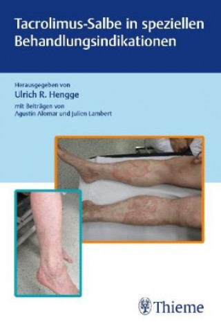 Könyv Tacrolimus-Salbe in speziellen Behandlungsindikationen Ulrich R. Hengge