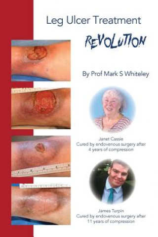 Kniha Leg Ulcer Treatment Revolution Mark S. Whiteley