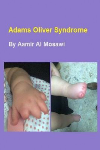 Kniha Adams Oliver syndrome: Clinical genetics Aamir Jalal Al Mosawi