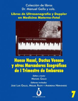 Kniha Hueso Nasal, Ductus Venoso Y Otros Marcadores Ecográficos de I Trimestre de Embarazo Jose Padilla