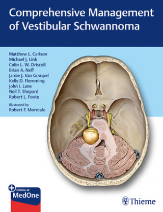 Carte Comprehensive Management of Vestibular Schwannoma Matthew L. Carlson