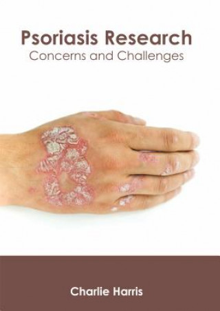 Kniha Psoriasis Research: Concerns and Challenges Charlie Harris