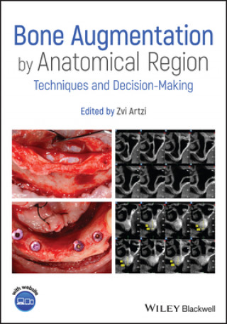 Knjiga Bone Augmentation by Anatomical Region - Techniques and Decision-Making 