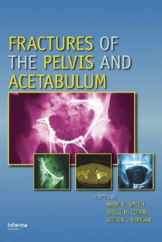 Buch Fractures of the Pelvis and Acetabulum 