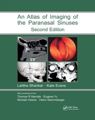 Książka Atlas of Imaging of the Paranasal Sinuses, Second Edition 