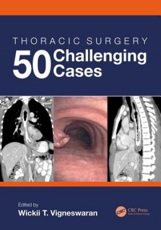 Kniha Thoracic Surgery: 50 Challenging cases 