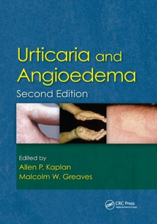 Książka Urticaria and Angioedema 