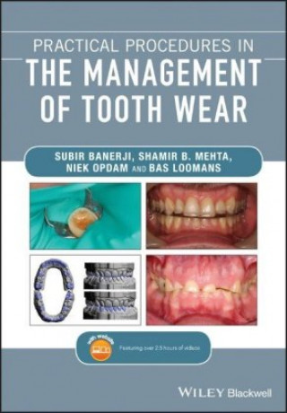 Könyv Practical Procedures in the Management of Tooth Wear Subir Banerji