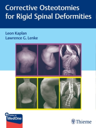 Kniha Corrective Osteotomies for Rigid Spinal Deformities Leon Kaplan