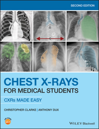 Kniha Chest X-Rays for Medical Students Anthony Dux