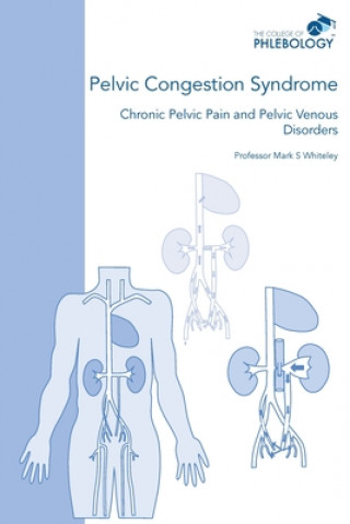 Könyv Pelvic Congestion Syndrome - Chronic Pelvic Pain and Pelvic Venous Disorders Mark S Whiteley