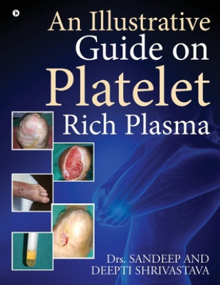 Książka Illustrative Guide on Platelet Rich Plasma Dr Deepti Shrivastava