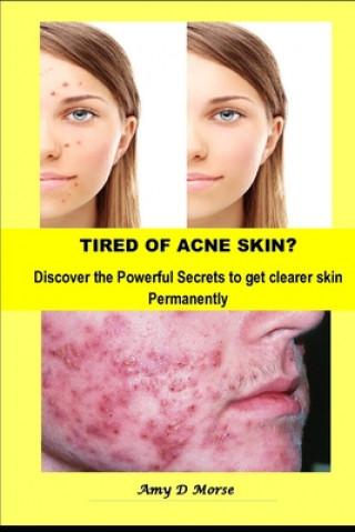 Carte TIRED OF ACNE SKIN? Discover the Powerful Secrets to get clearer skin Permanently Amy D. Morse