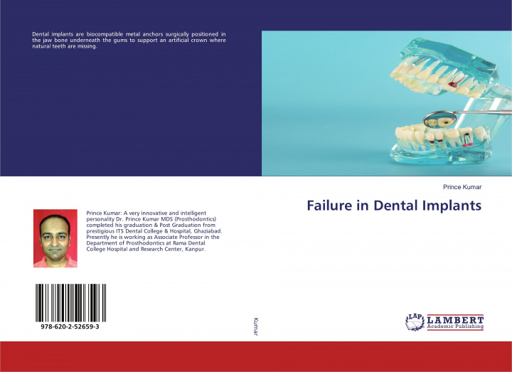 Knjiga Failure in Dental Implants Prince Kumar