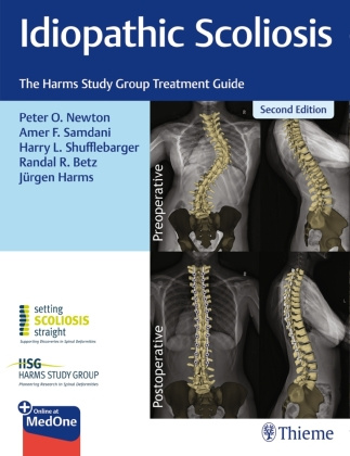 Carte Idiopathic Scoliosis Amer F. Samdani