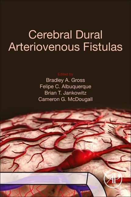 Carte Cerebral Dural Arteriovenous Fistulas Felipe C. Albuquerque
