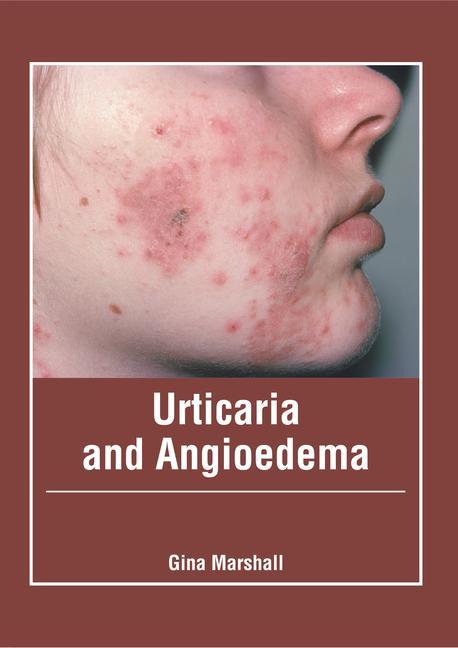 Kniha Urticaria and Angioedema 