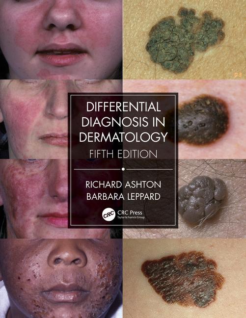 Kniha Differential Diagnosis in Dermatology Richard Ashton