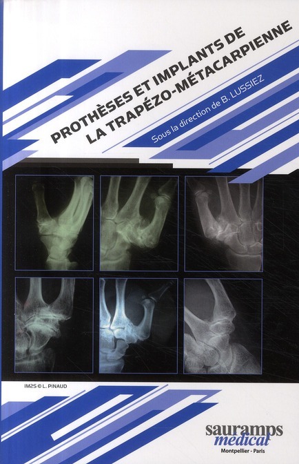 Carte PROTHESES ET IMPLANTS DE LA TRAPEZO METACARPIENNE LUSSIEZ B/ COLL