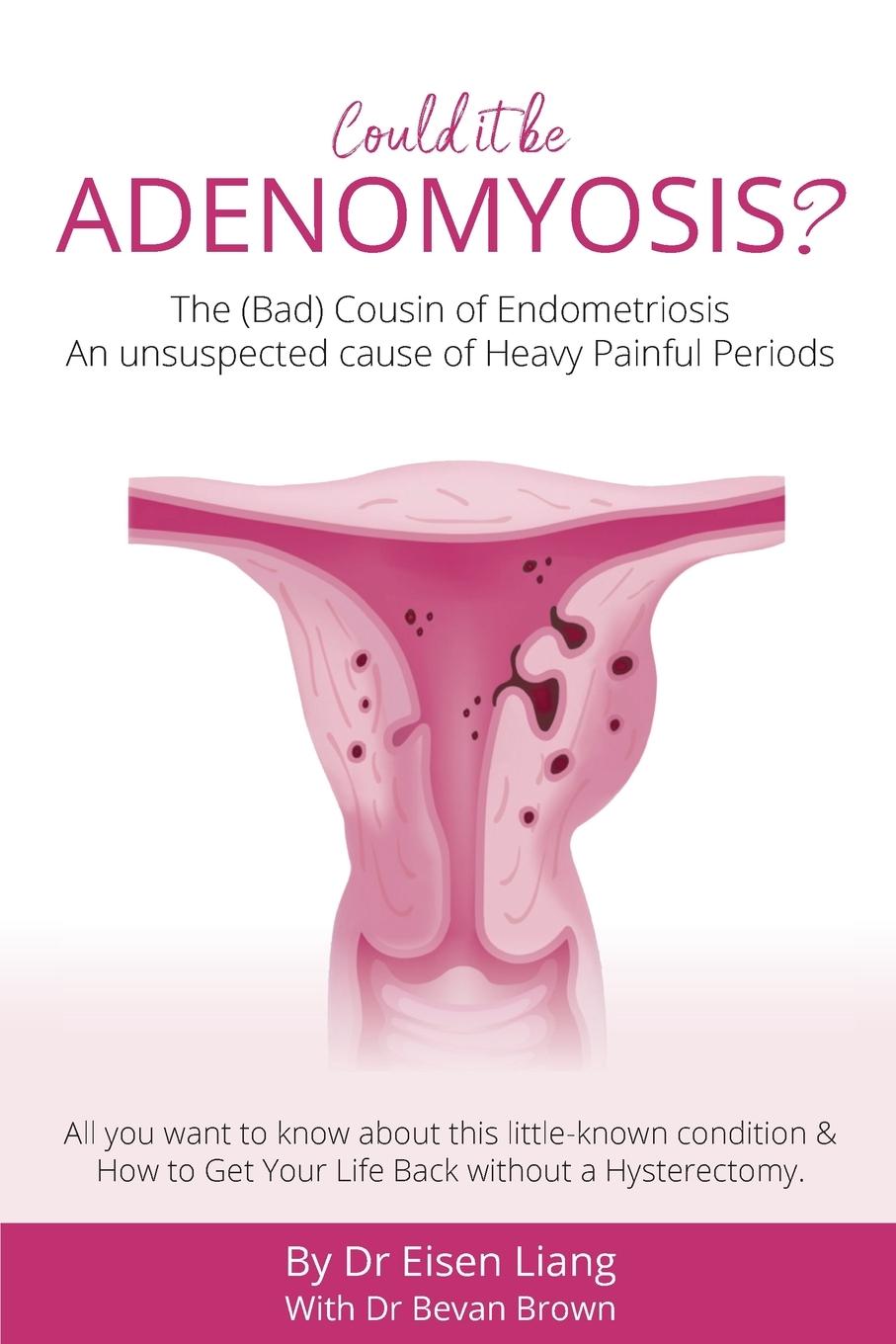 Kniha Adenomyosis -The Bad Cousin of Endometriosis EISEN LIANG
