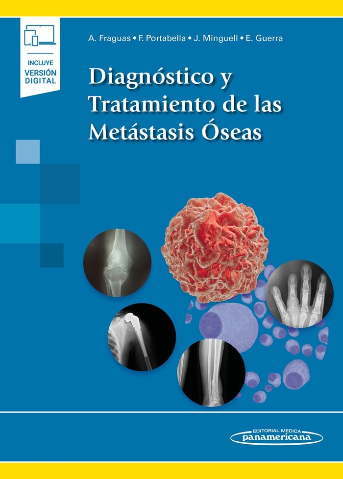 Книга Diagnóstico y Tratamiento de las Metástasis Óseas (incluye versión digital) Fraguas i Castany
