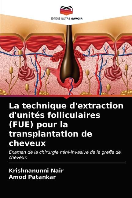 Carte technique d'extraction d'unites folliculaires (FUE) pour la transplantation de cheveux Nair Krishnanunni Nair