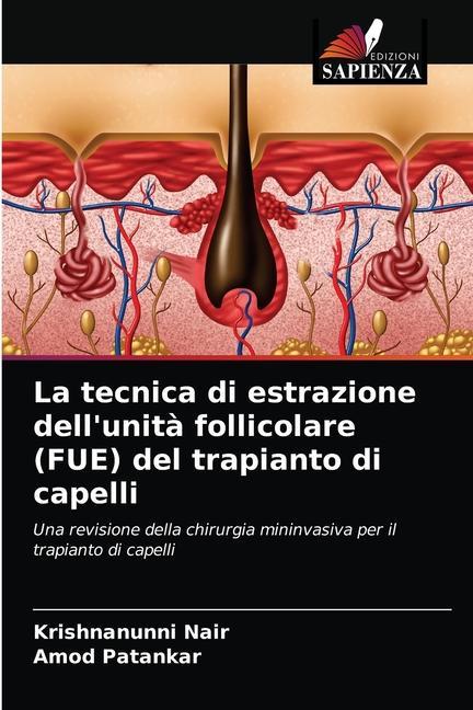 Kniha tecnica di estrazione dell'unita follicolare (FUE) del trapianto di capelli Nair Krishnanunni Nair