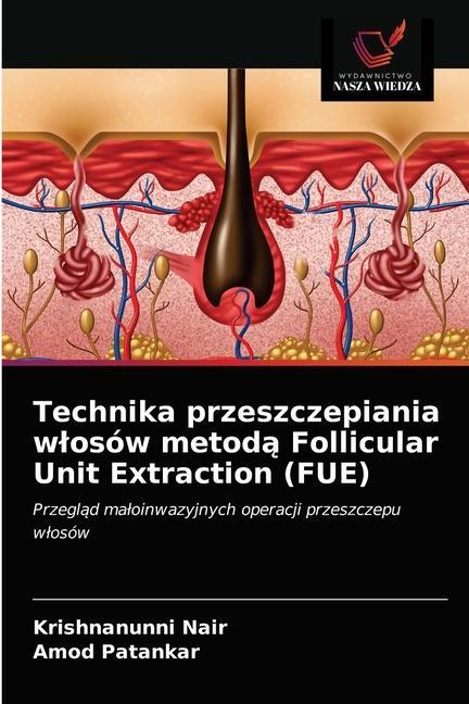 Carte Technika przeszczepiania wlosow metod&#261; Follicular Unit Extraction (FUE) Nair Krishnanunni Nair