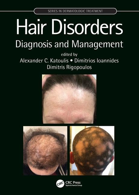 Book Hair Disorders Alexander C. Katoulis