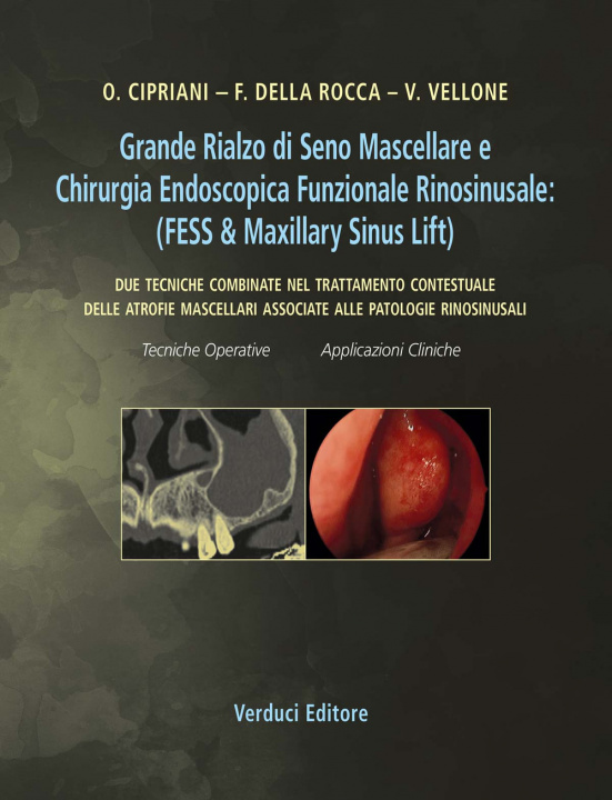 Könyv Grande rialzo di seno mascellare e chirurgia endoscopica funzionale rinosinusale. Due tecniche combinate nel trattamento contestuale delle atrofie mas 
