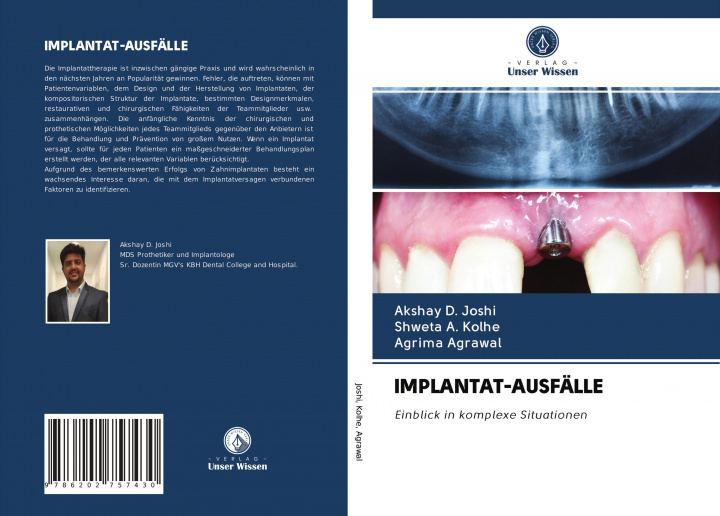 Knjiga IMPLANTAT-AUSFÄLLE Shweta A. Kolhe