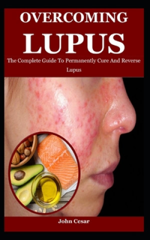Kniha Overcoming Lupus John Cesar
