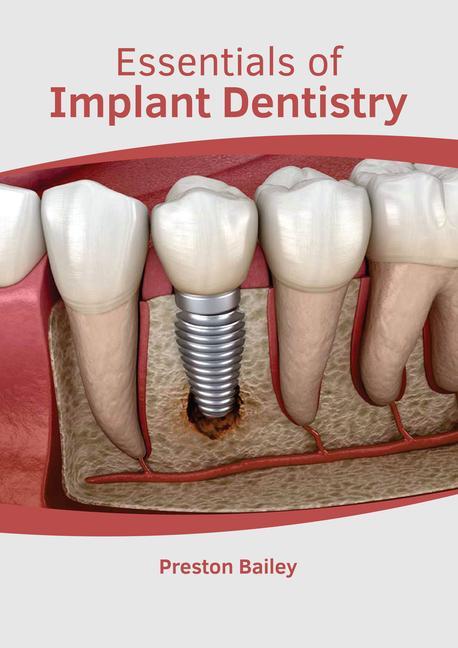 Книга Essentials of Implant Dentistry 