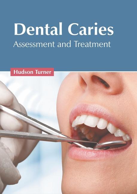 Carte Dental Caries: Assessment and Treatment 