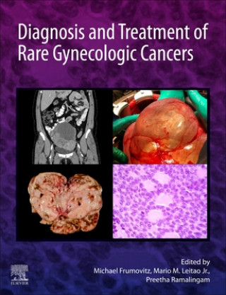Kniha Diagnosis and Treatment of Rare Gynecologic Cancers Michael Frumovitz