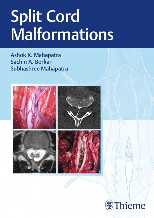 Knjiga Split Cord Malformations Sachin Borkar