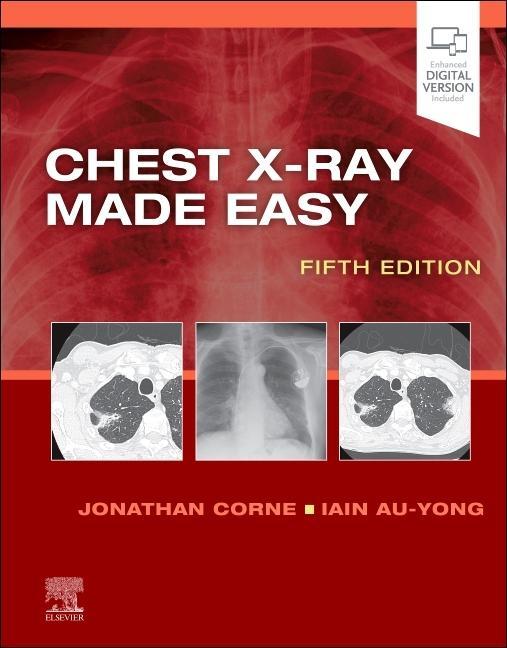 Книга Chest X-Ray Made Easy JONATHAN CORNE