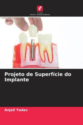 Knjiga Projeto de Superfície do Implante Anjali Yadav