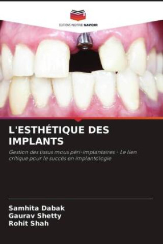 Book L'ESTHÉTIQUE DES IMPLANTS Gaurav Shetty