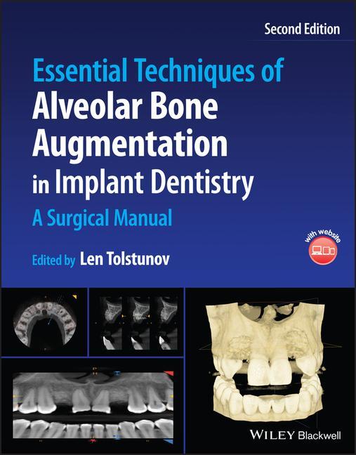 Книга Essential Techniques of Alveolar Bone Augmentation in Implant Dentistry 